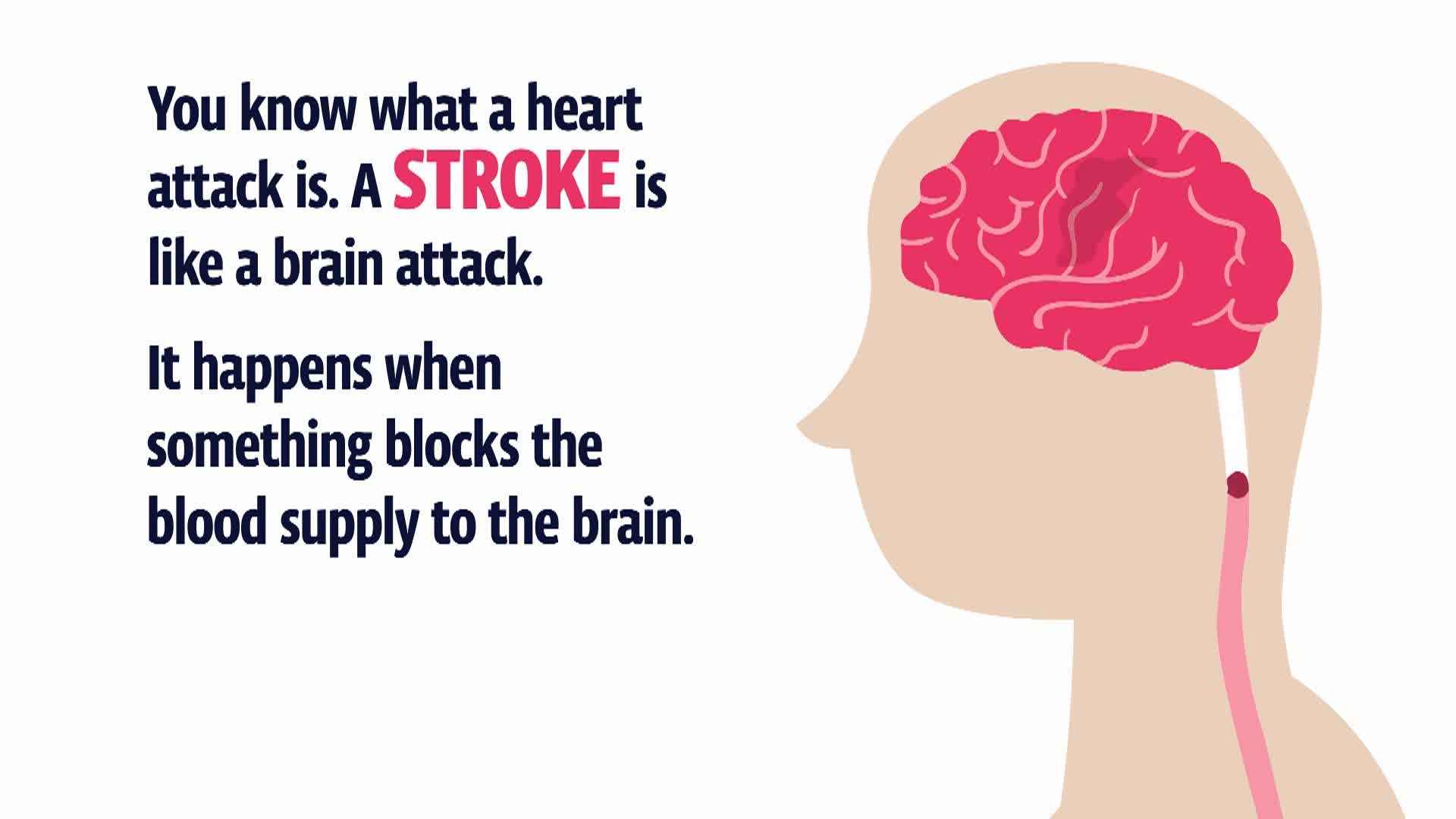 Florida Health | Stroke Use F.A.S.T.